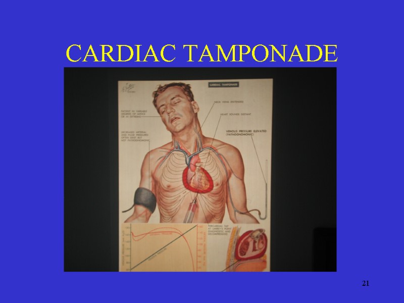 21 CARDIAC TAMPONADE